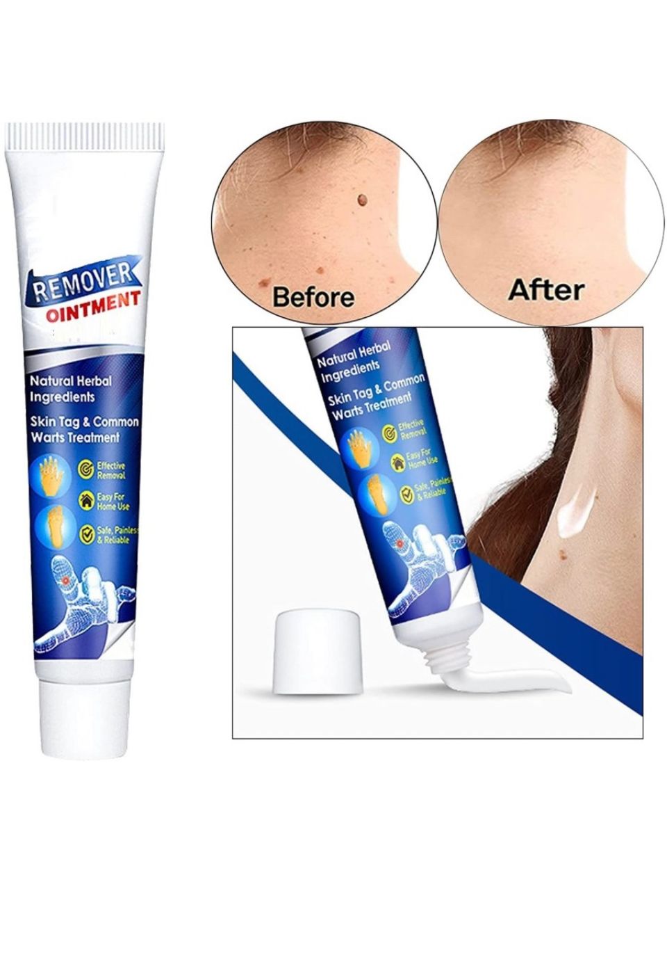 Warts Remover Cream Extract Skin Face Tag Extract Corn Treatment Ointment Painless For Men Women